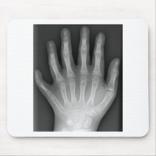 Polydactyly, Six Fingered Hand, X-Ray, zeldzaamhei Muismat
