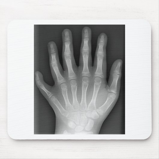 Polydactyly, Six Fingered Hand, X-Ray, zeldzaamhei Muismat (Voorkant)