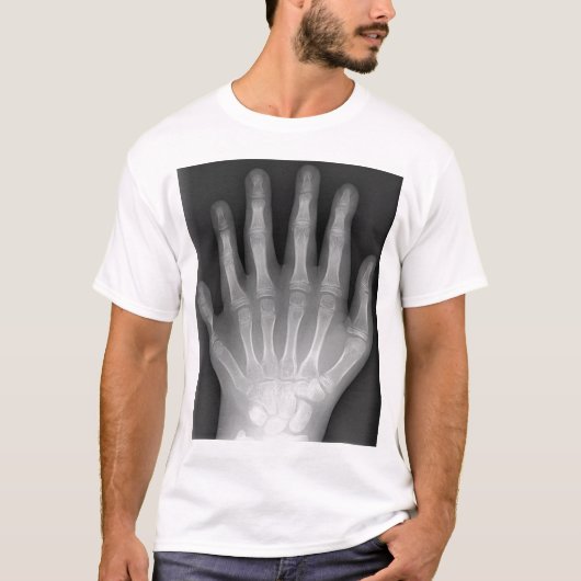 Polydactyly, Six Fingered Hand, X-Ray, zeldzaamhei T-shirt (Voorkant)