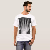 Polydactyly, Six Fingered Hand, X-Ray, zeldzaamhei T-shirt (Voorkant volledig)
