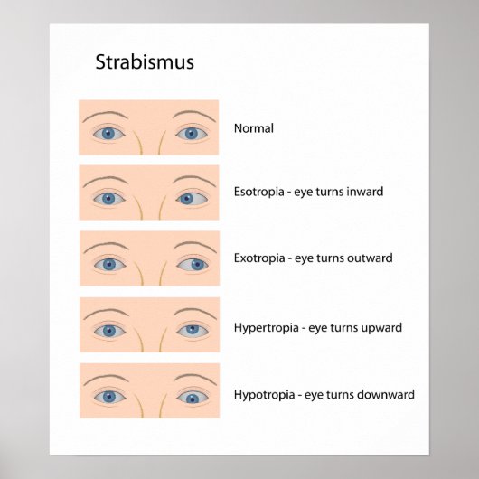 Poster met strabismus-oogdefect (Voorkant)