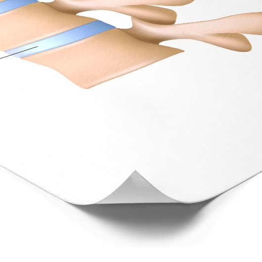 Poster Spondylitis ankylopoetica (Hoek)