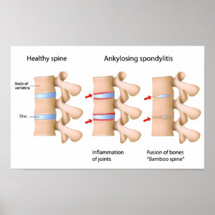 Poster Spondylitis ankylopoetica