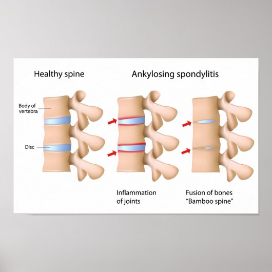 Poster Spondylitis ankylopoetica (Voorkant)
