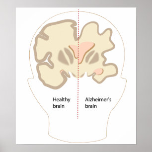 Poster van Alzheimer
