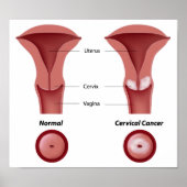 Poster van baarmoederhalskanker (Voorkant)