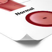 Poster van baarmoederhalskanker (Hoek)