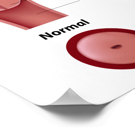 Poster van baarmoederhalskanker (Hoek)