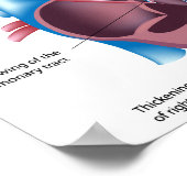 Poster van congenitale hartaandoeningen (Hoek)