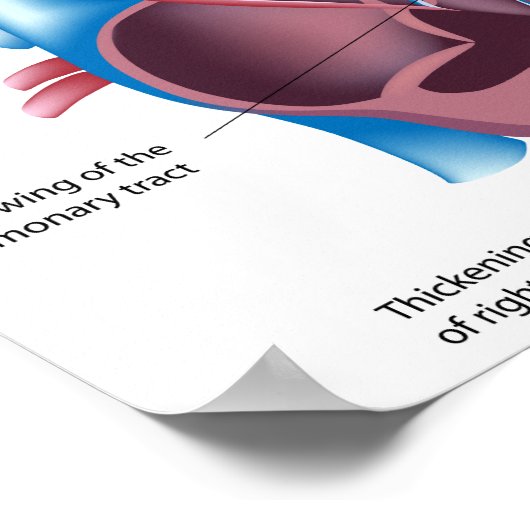 Poster van congenitale hartaandoeningen (Hoek)