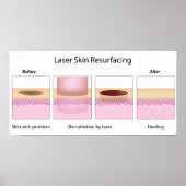 Poster van de laserhuidherurbietprocedure (Voorkant)