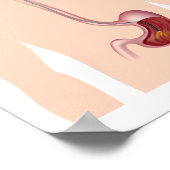 Poster van het bovenste GI endoscopie (Hoek)