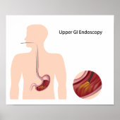 Poster van het bovenste GI endoscopie (Voorkant)