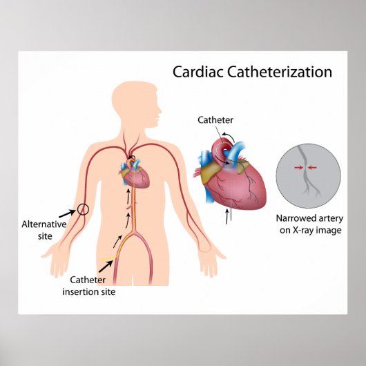 Poster voor cardiale catheterisatie (Voorkant)