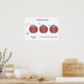 Poster voor cataractoperatie (Keuken)