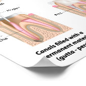 Poster voor de behandeling van wortelkanaalbehande (Hoek)