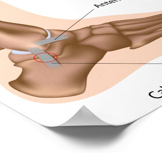 Poster voor het indelen van zijdelingse enkels (Hoek)