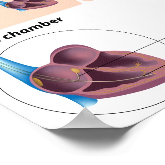 Poster voor inbrengen van pacemaker (Hoek)