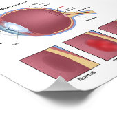 Poster voor oogmaculadegeneratie (Hoek)