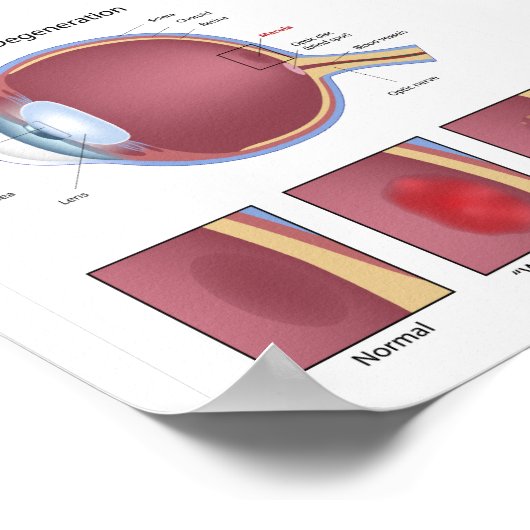Poster voor oogmaculadegeneratie (Hoek)