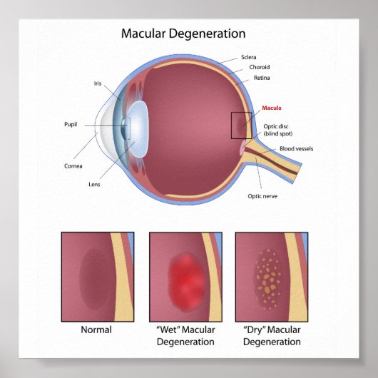 Poster voor oogmaculadegeneratie (Voorkant)