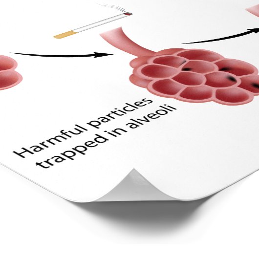 Poster voor roken en emfysisch gebruik (Hoek)