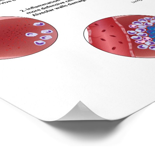 Progressie van het pulmonale tuberculose Poster (Hoek)