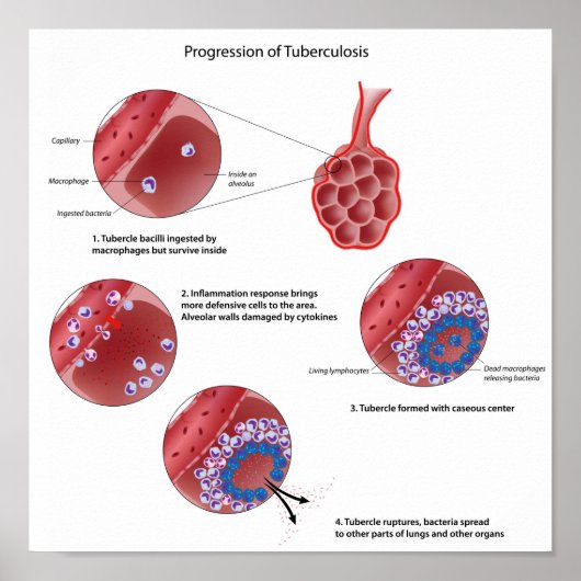Progressie van het pulmonale tuberculose Poster (Voorkant)