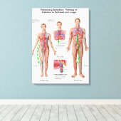 Pulmonaire embolie, route van embolus canvas afdruk (Insitu (Houten vloer))