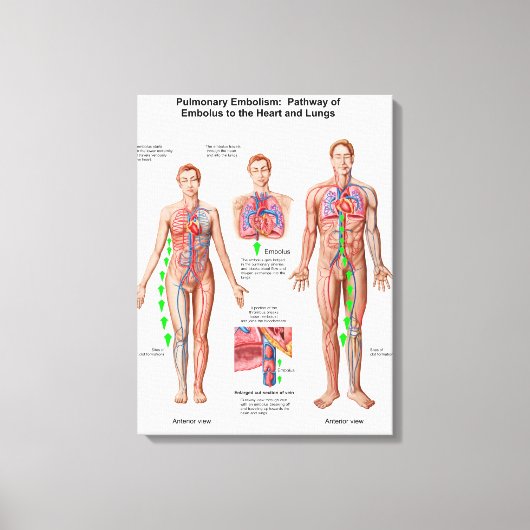 Pulmonaire embolie, route van embolus canvas afdruk (Voorkant)