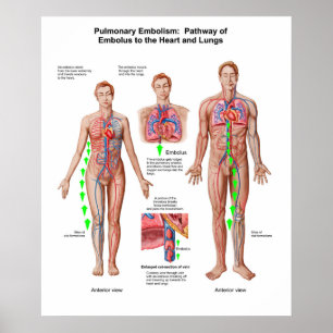Pulmonaire embolie, route van embolus poster