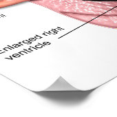 Pulmonale hypertensie poster (Hoek)