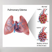 Pulmonary edema Poster (Voorkant)