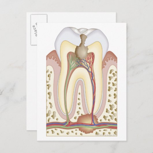 Pulp- en wortelabscess briefkaart (Voorkant / Achterkant)
