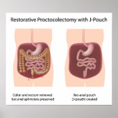 Restoratieve proctocolectomie chirurgie met j-pouc poster (Voorkant)