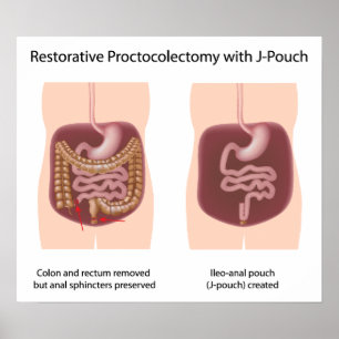 Restoratieve proctocolectomie chirurgie met j-pouc poster