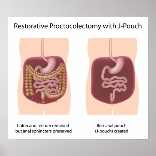 Restoratieve proctocolectomie chirurgie met j-pouc poster (Voorkant)
