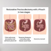 Restoratieve proctocolectomie met j-pouch 2 fasen poster (Voorkant)