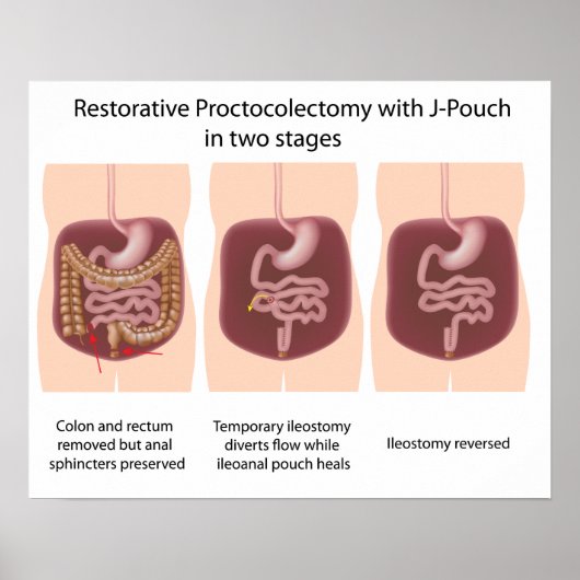 Restoratieve proctocolectomie met j-pouch 2 fasen poster (Voorkant)