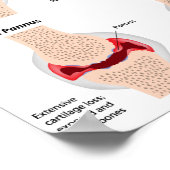 Reumatoïde artritis Poster (Hoek)