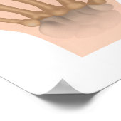 Reumatoïde artritis van vingergewrichten, diagram. poster (Hoek)