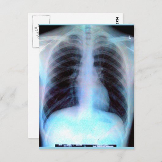 Ribcage Xray Skeleton Briefkaart (Voorkant / Achterkant)