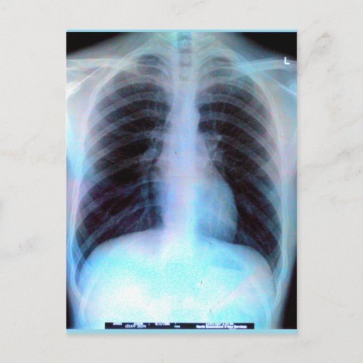 Ribcage Xray Skeleton Briefkaart (Voorkant)