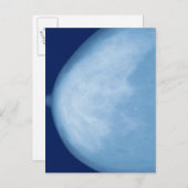 Röntgenfoto van borst van vrouwen, uitzicht aan de briefkaart (Voorkant / Achterkant)