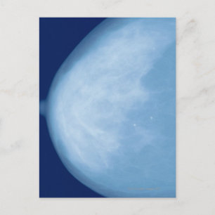 Röntgenfoto van borst van vrouwen, uitzicht aan de briefkaart