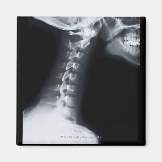 Röntgenfoto van halswervels inclusief onderkaak magneet (Voorkant)