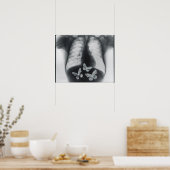 Röntgenfoto van vlinders in de maag poster (Keuken)