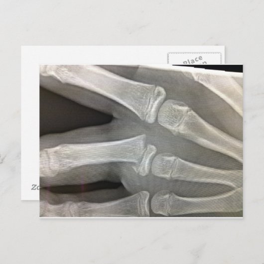 röntgengebroken bot wordt snel goed briefkaart (Voorkant / Achterkant)