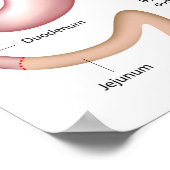 Roux-en-Y Gastric Bypass poster (Hoek)