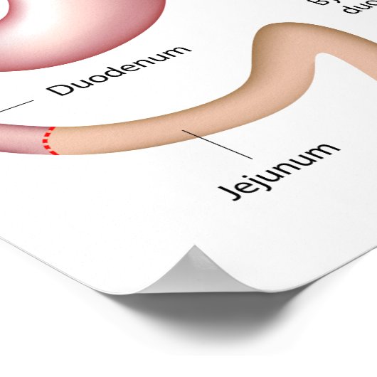Roux-en-Y Gastric Bypass poster (Hoek)